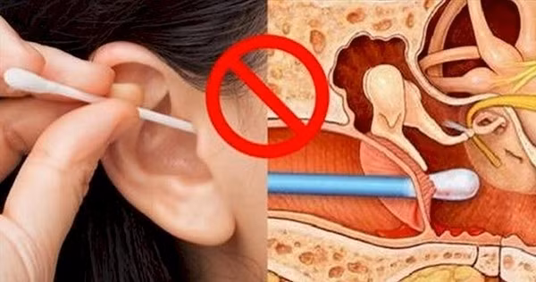 Không nên lấy ráy tai với bất kỳ đồ vật gì như bút bi, chìa khóa, tăm..