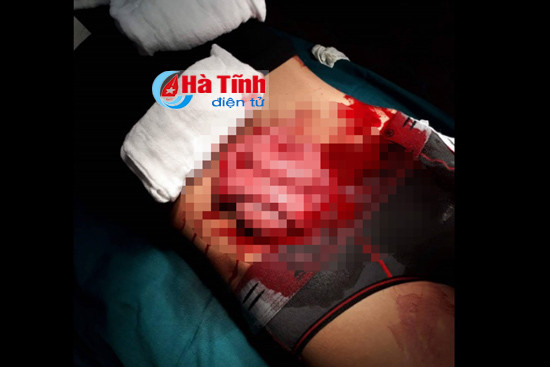 2 thanh nien bi dam phai cap cuu trong tinh trang nguy kich