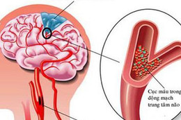 Những thói quen xấu khiến bạn dễ bị đột quỵ