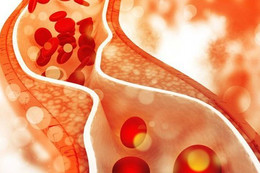 Cải thiện cholesterol máu cần chú ý 5 điều sau