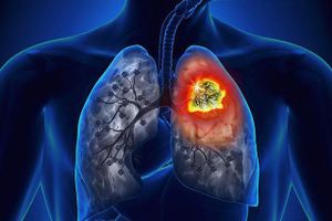 5 dấu hiệu nhận biết sớm ung thư phổi