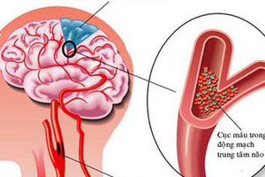 Những thói quen xấu khiến bạn dễ bị đột quỵ