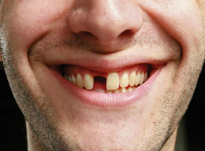 Nhật Bản phát triển thuốc giúp kích thích răng mọc trở lại