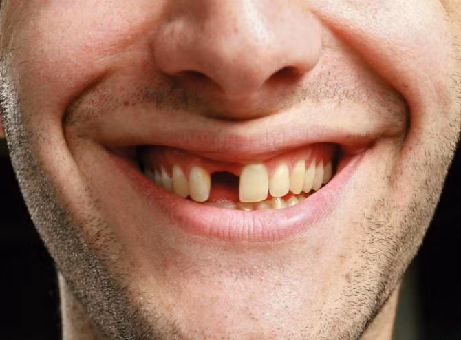 Nhật Bản phát triển thuốc giúp kích thích răng mọc trở lại