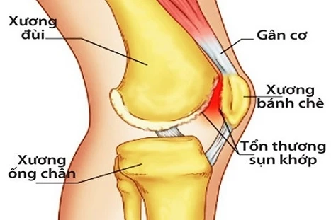 Triệu chứng sớm của viêm khớp gối không nên bỏ qua