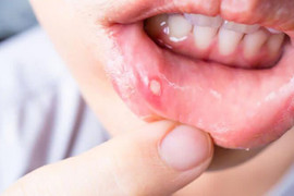 Nhiệt miệng mùa hè: Dấu hiệu cảnh báo cơ thể đang “nóng trong”?