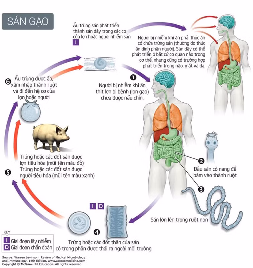 Xét nghiệm sán lợn - hiểu thế nào cho đúng?
