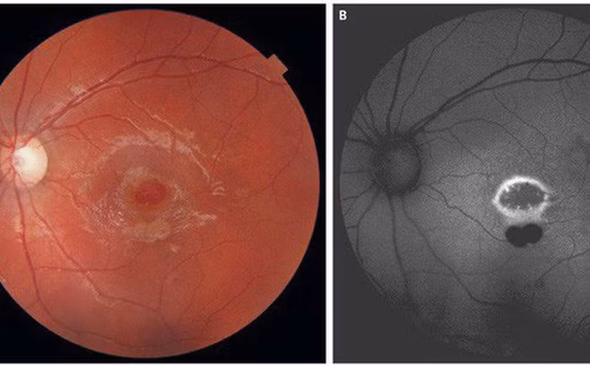 Cảnh giác với biến chứng của viêm loét giác mạc