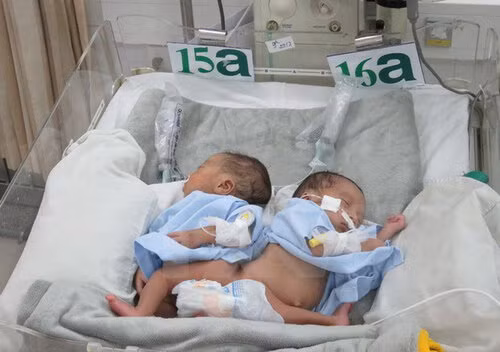 8 ca song sinh dính liền được phẫu thuật tách rời ở Việt Nam