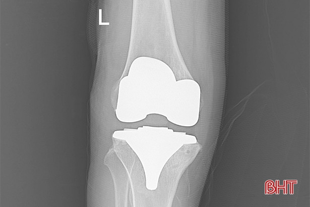 BVĐK Hà Tĩnh thay thành công khớp gối toàn phần cho 2 bệnh nhân ảnh 4 BVĐK Hà Tĩnh thay thành công khớp gối toàn phần cho 2 bệnh nhân