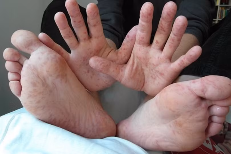 Bệnh tay chân miệng có nguy cơ bùng phát mùa tựu trường