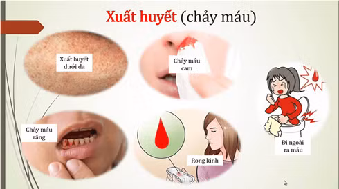 Bác sĩ chỉ rõ 2 biến chứng nguy hiểm của sốt xuất huyết