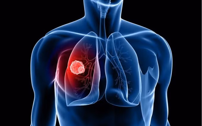 Minh họa khối u ung thư phổi. Ảnh: Unplash