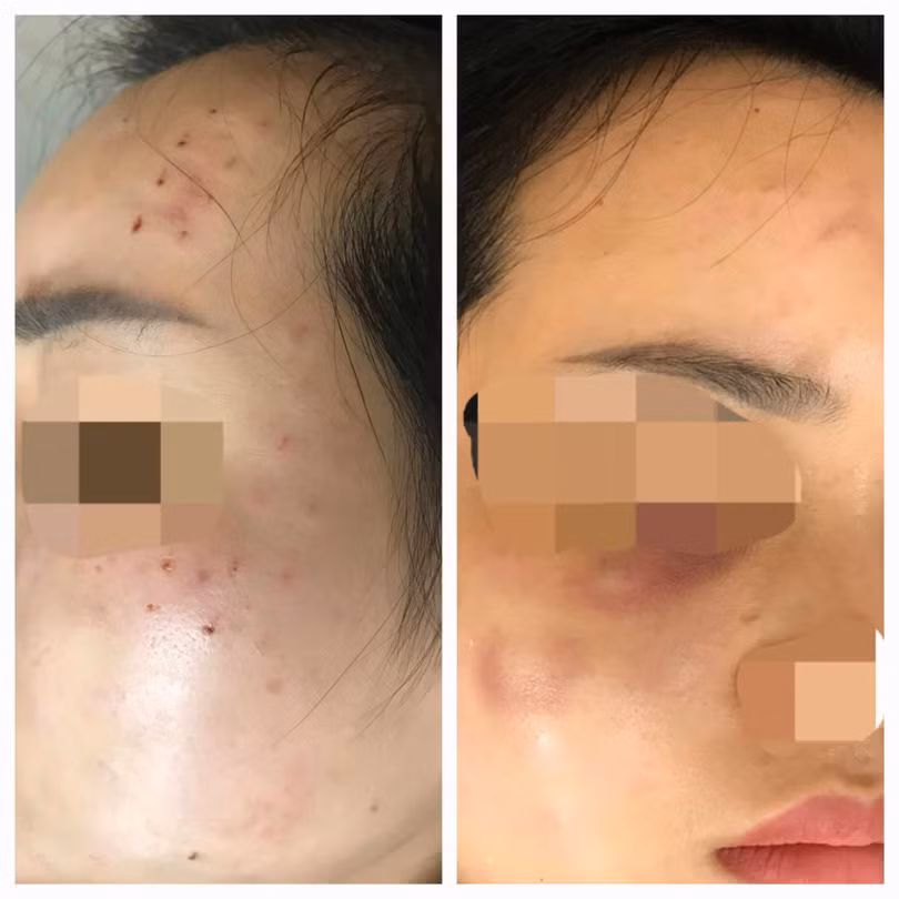 Nữ bệnh nhân bị tiêm nhầm sữa rửa mặt vào da. Ảnh: Quỳnh Mai