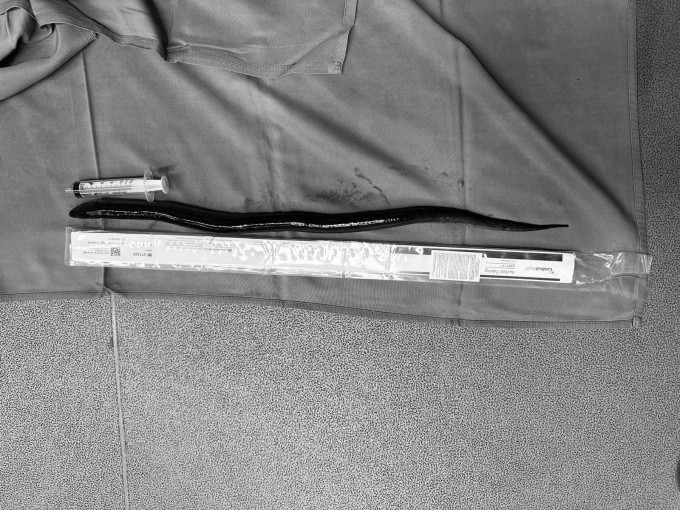 Con lươn được bác sĩ gắp ra từ ổ bụng của bệnh nhân. Ảnh Trung tâm Y tế huyện Hải Hà