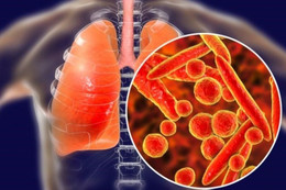 Cẩn trọng với các biến chứng của lao phổi 