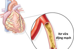 Cảnh báo nguy cơ nhồi máu cơ tim dịp lễ, Tết gia tăng