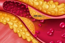 Mỡ máu cao không được chủ quan, kể cả người gầy
