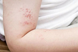 Những điều cần biết về bệnh zona thần kinh