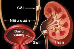 "Sỏi im lặng" âm thầm gây biến chứng nặng