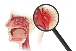 Biểu hiện cảnh báo ung thư vòm họng giai đoạn đầu
