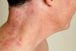 Vì sao người lớn tuổi dễ mắc bệnh zona thần kinh?