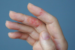 Bị viêm da cơ địa khi thời tiết hanh khô cần lưu ý những gì?