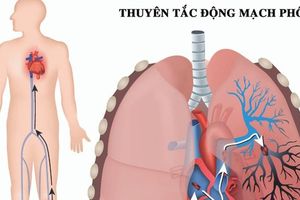 Cẩn thận bệnh "sát thủ ẩn mình" thuyên tắc động mạch phổi gây tử vong nhanh trong 1-2 giờ