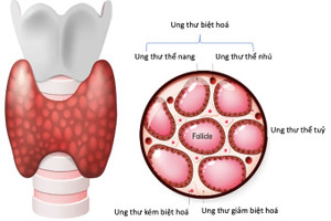 Các dấu hiệu sớm của ung thư tuyến giáp cần biết