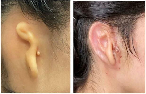 Hoa Kỳ lần đầu tiên cấy ghép tai được in từ tế bào người