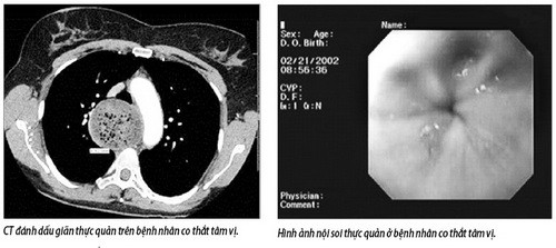 Nuốt nghẹn liên tục: Coi chừng co thắt tâm vị