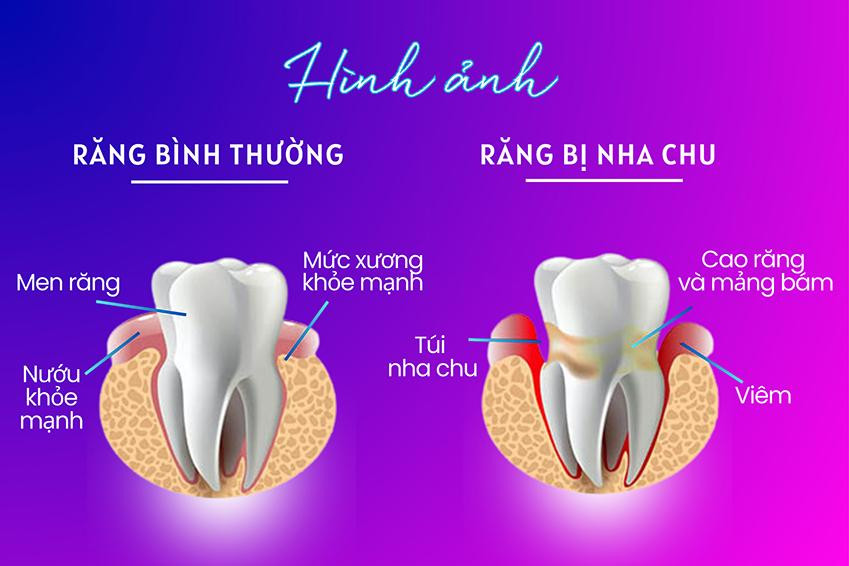 Khác biệt giữa răng bình thường và răng bị nha chu.