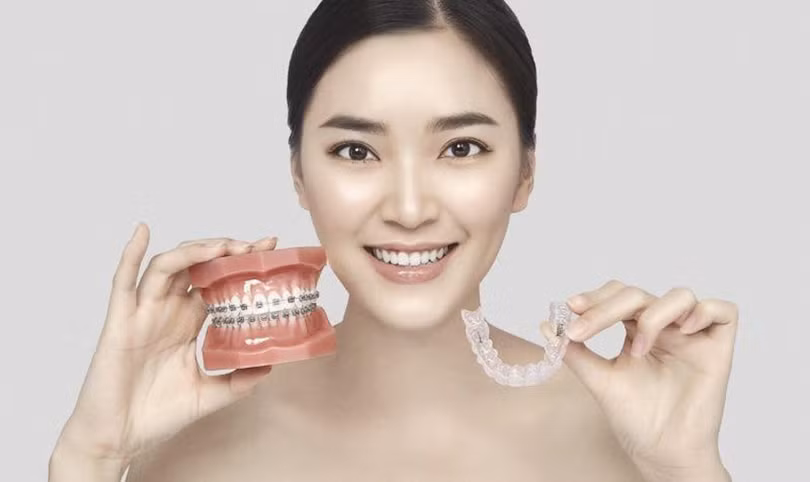 niềng răng 3.jpg