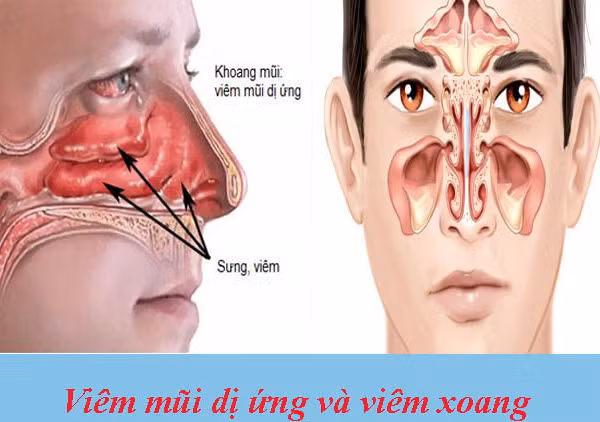 Cách phân biệt viêm xoang và viêm mũi dị ứng