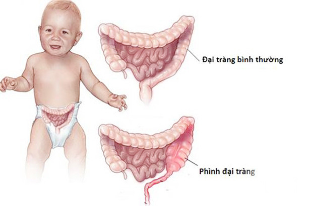 Phẫu thuật nội soi thành công cho bệnh nhi bị phình đại tràng bẩm sinh