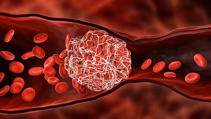 Cảnh giác với biến chứng đột quỵ hậu COVID-19