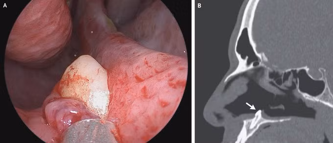 Khó thở nhiều năm, người đàn ông phát hiện răng mọc trong mũi
