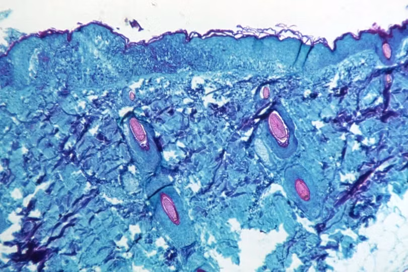 WHO họp khẩn vì virus bệnh đậu khỉ lan rộng ở châu Âu