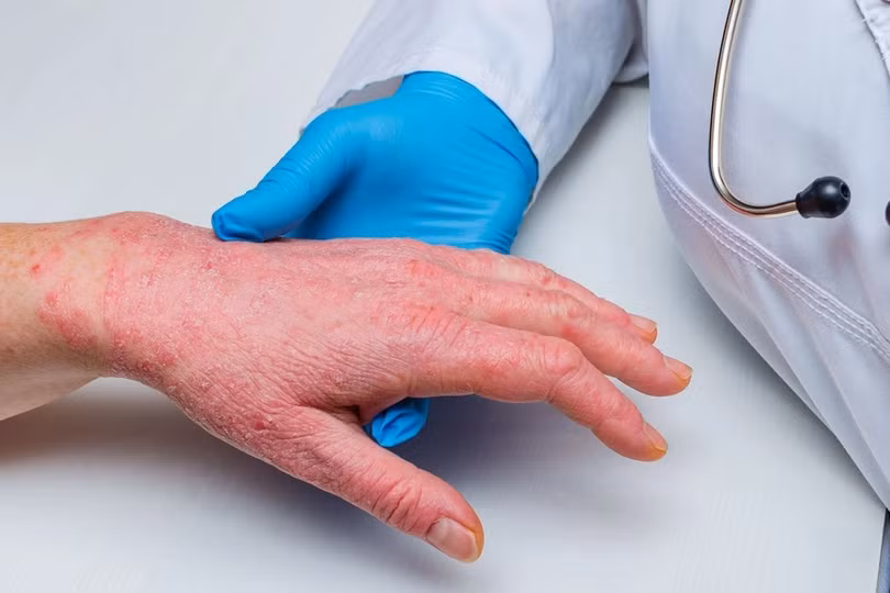 Virus gây bệnh hiếm gặp đã lan sang Mỹ