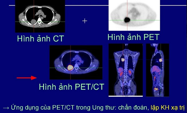 benh nhan ung thu phoi di can khap co the van chua khoi