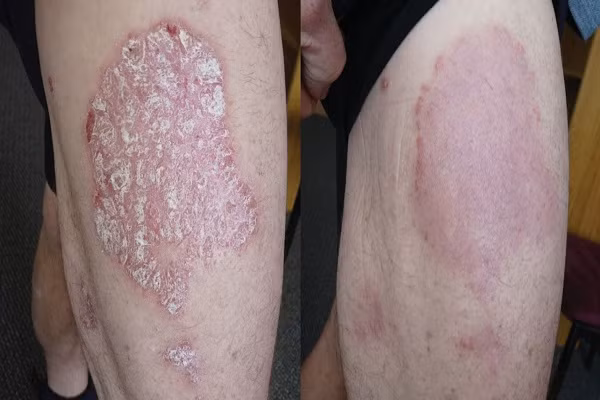 Điểm mặt bệnh về da thường gặp vào mùa hè