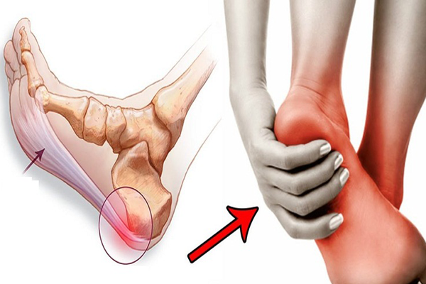 Cẩn thận viêm cân gan chân do đi bốt cao