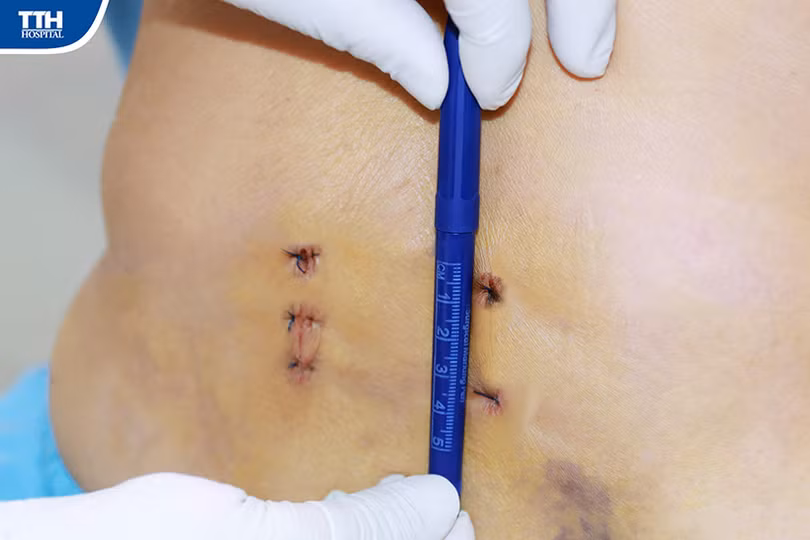 Bệnh viện Đa khoa TTH Hà Tĩnh triển khai thành công kỹ thuật mới MIS TLIF