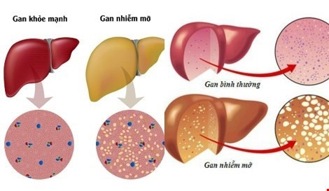 Những dấu hiệu nhận biết bệnh gan nhiễm mỡ ảnh 1 Những dấu hiệu nhận biết bệnh gan nhiễm mỡ ảnh 1
