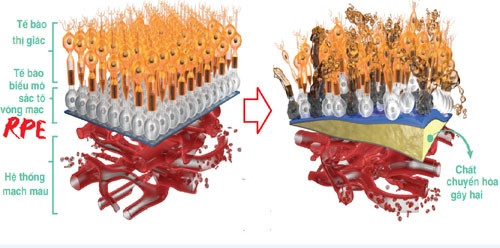 Tế bào biểu mô sắc tố võng mạc - RPE suy yếu dưới tác động của ánh sáng xanh.