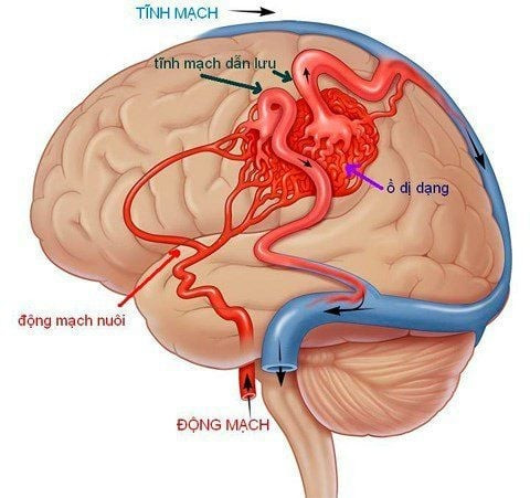 Hình ảnh dị dạng mạch máu não Hình ảnh dị dạng mạch máu não