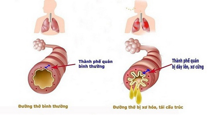 Tìm ra căn nguyên gây bệnh viêm đường hô hấp mạn tính