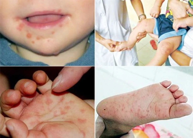 Sở Y tế Hà Tĩnh “lên dây cót” phòng, chống dịch tay chân miệng