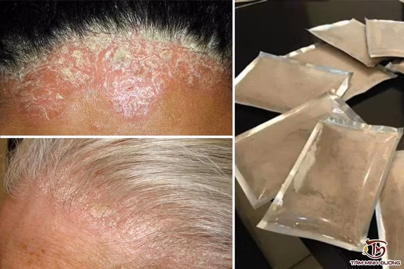 Cách chữa vảy nến da đầu tại nhà cùng chuyên gia Iwt Hà Nội