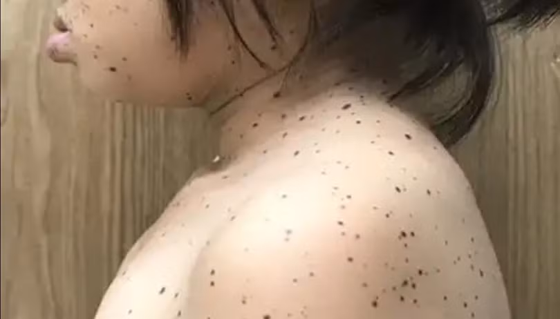 Việt Nam ghi nhận trường hợp đầu tiên mắc hội chứng “da báo”